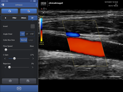 SONON Ultrasound App para PC