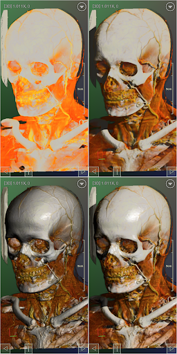 DroidRender - 3D DICOM viewer PC