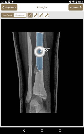 Osteotrauma PC