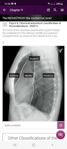 Chest X-Ray DEMO PC