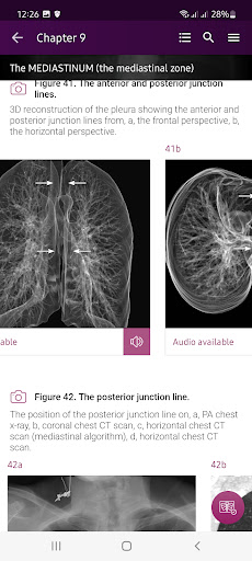 Chest X-Ray DEMO PC