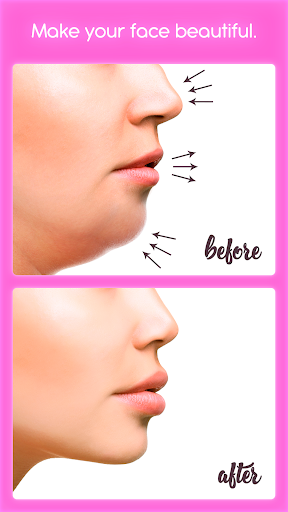 Rinoplastia